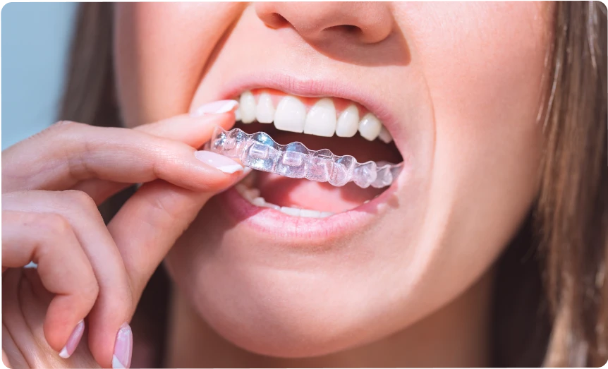 aligneurs invisibles implants dentaires nueil les aubiers Aligneurs invisibles Jeunesse