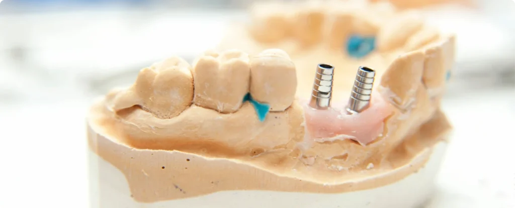 greffe osseuse implants dentaires nueil les aubiers Greffe osseuse Jeunesse