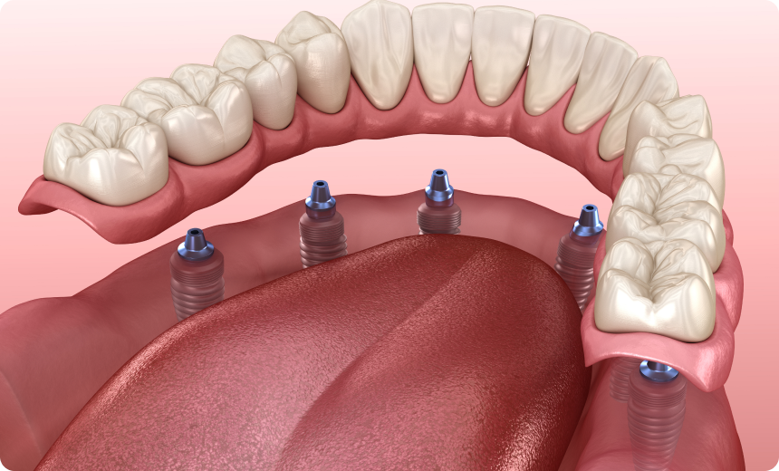 prothese fixe extraction implantation nueil les aubiers All-on-6 Jeunesse