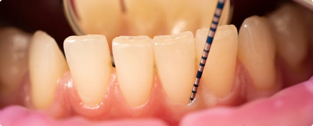 mplantologie avancee cabinet dentalart nueil les aubiers Surfaçage Jeunesse