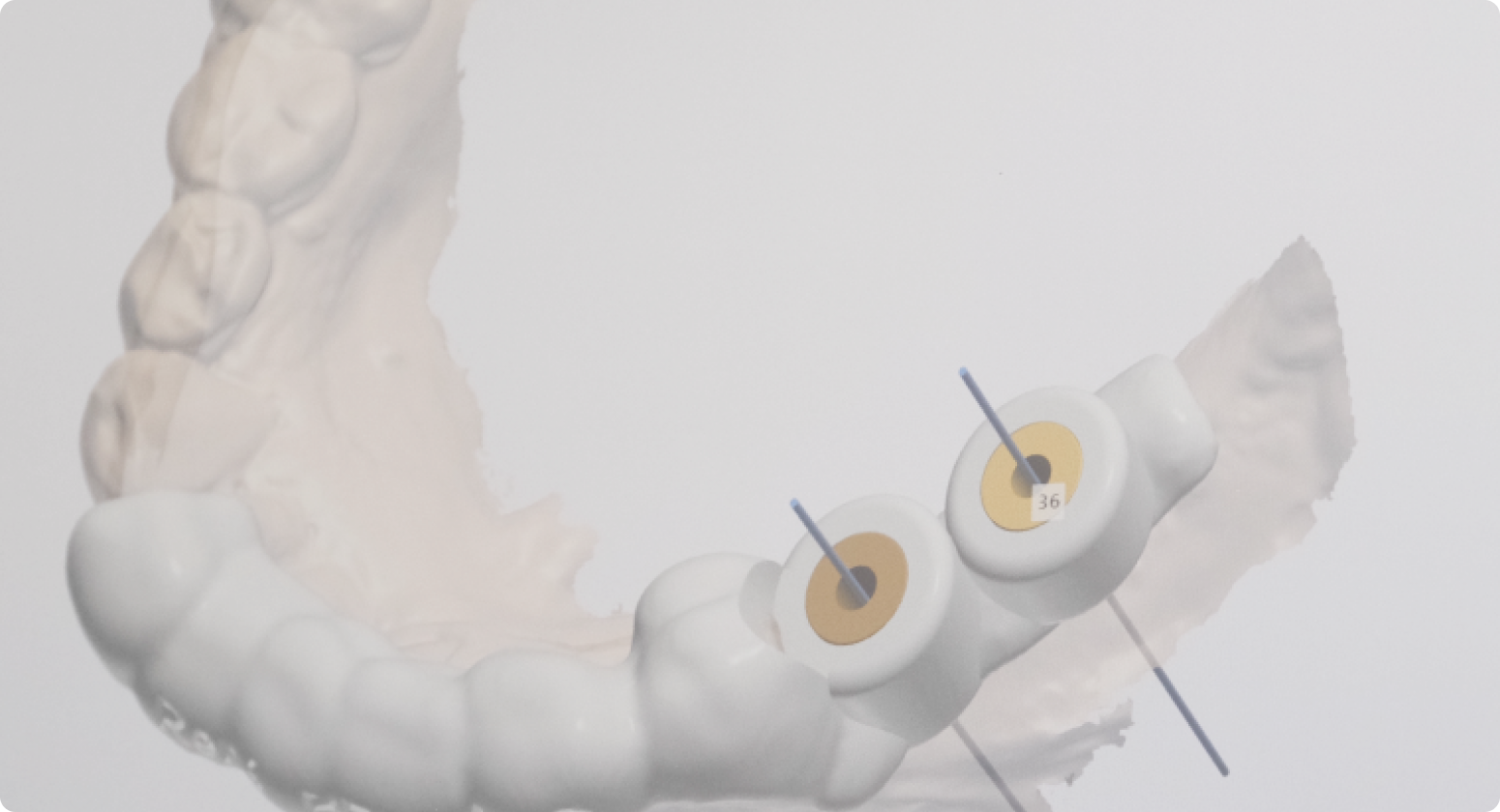 rehabilitation complete extraction implantation nueil les aubiers