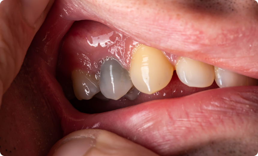 surcqge extraction implantation nueil les aubiers Kystes Jeunesse