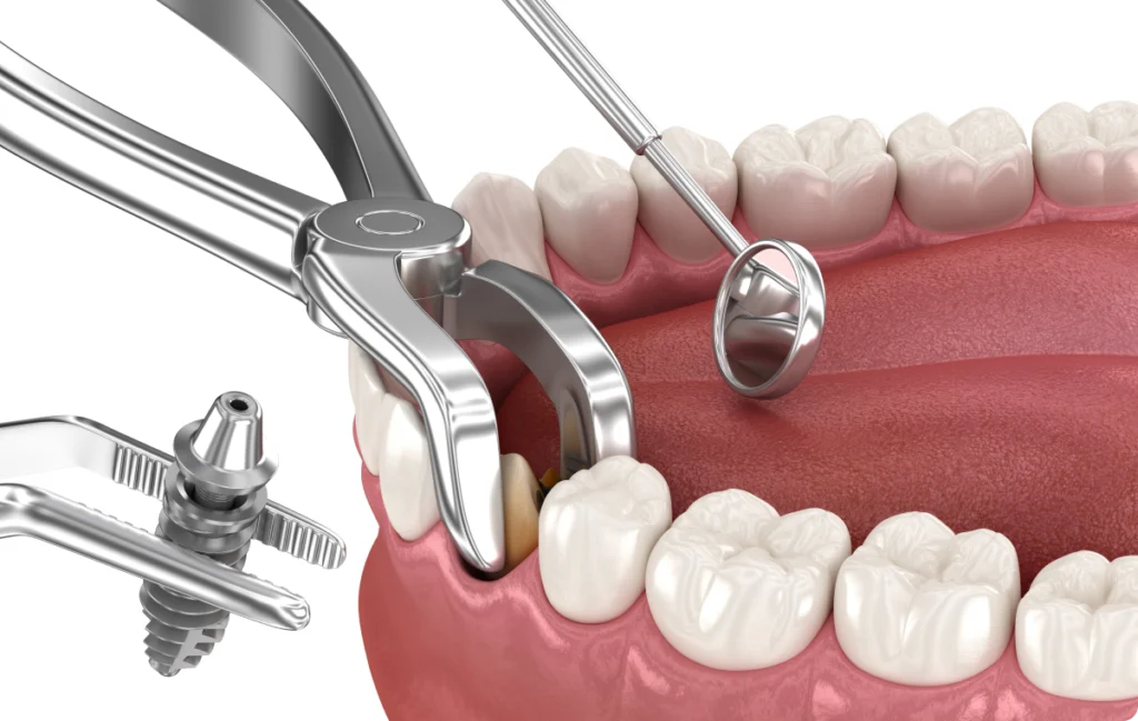 extraction implantation immediate implants dentaires nueil les aubiers Extraction dentaire Jeunesse