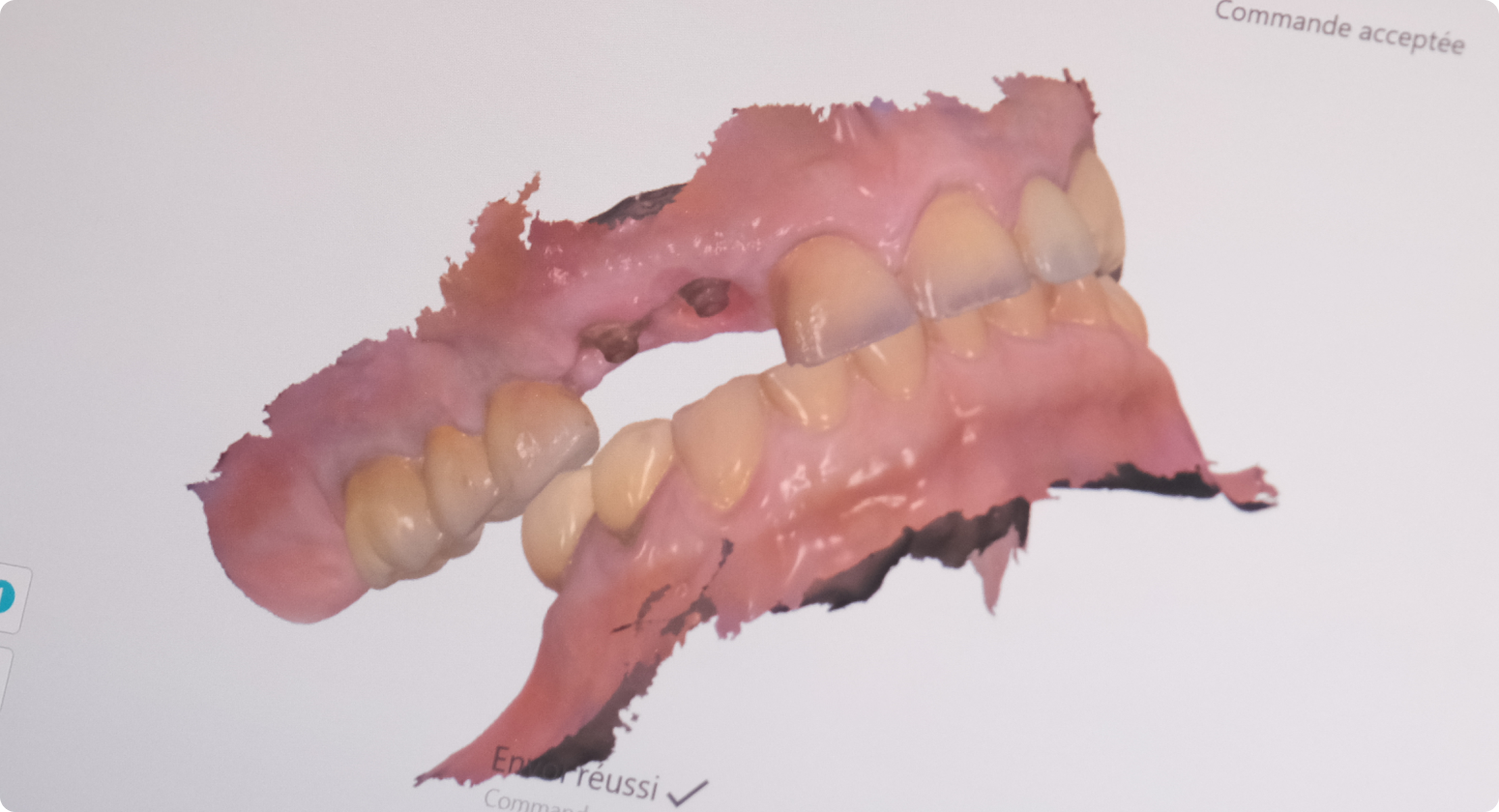 implants dentaires greffe sinus nueil les aubiers